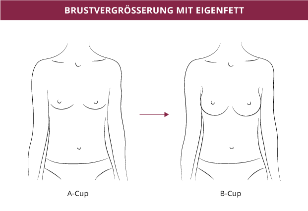 Brustvergrößerung mit Eigenfett, Klinik auf der Karlshöhe, Dr. Fitz 