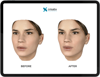 3D Crisalix 3D Gesicht, Klinik auf der Karlshöhe, Dr. Fitz 