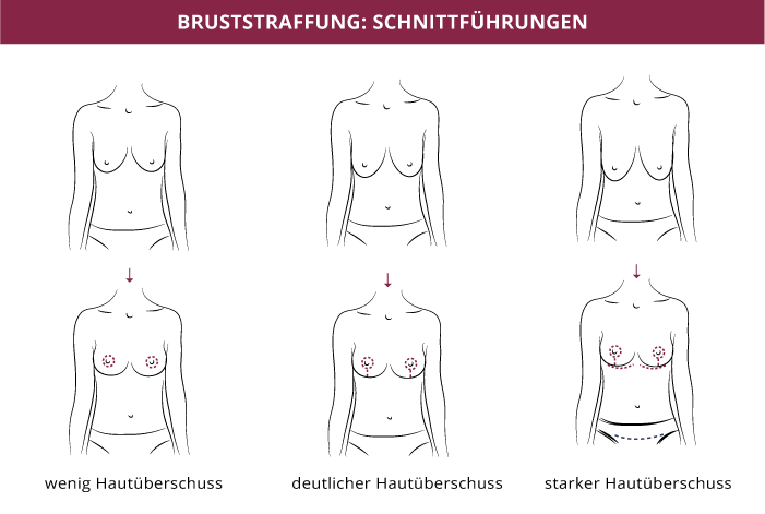 Bruststraffung Schnittführung, Klinik auf der Karlshöhe, Dr. Fitz 