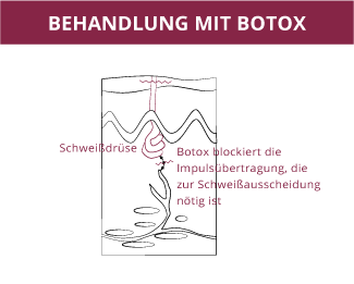 Hyperhidrose-Behandlung mit Botox, Klinik auf der Karlshöhe, Dr. Fitz 