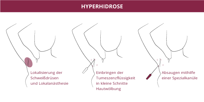 Hyperhidrose, Klinik auf der Karlshöhe, Dr. Fitz 