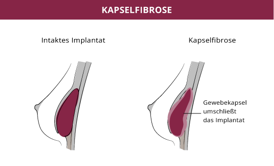 Kapselfibrose, Klinik auf der Karlshöhe, Dr. Fitz 