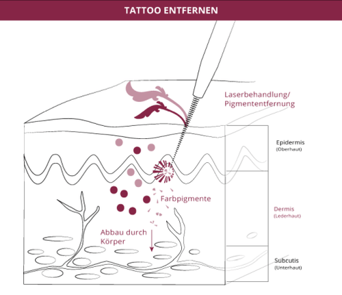 Tattoo entfernen, Klinik auf der Karlshöhe, Dr. Fitz 